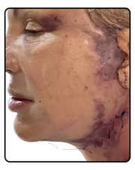 Surgery or Botox